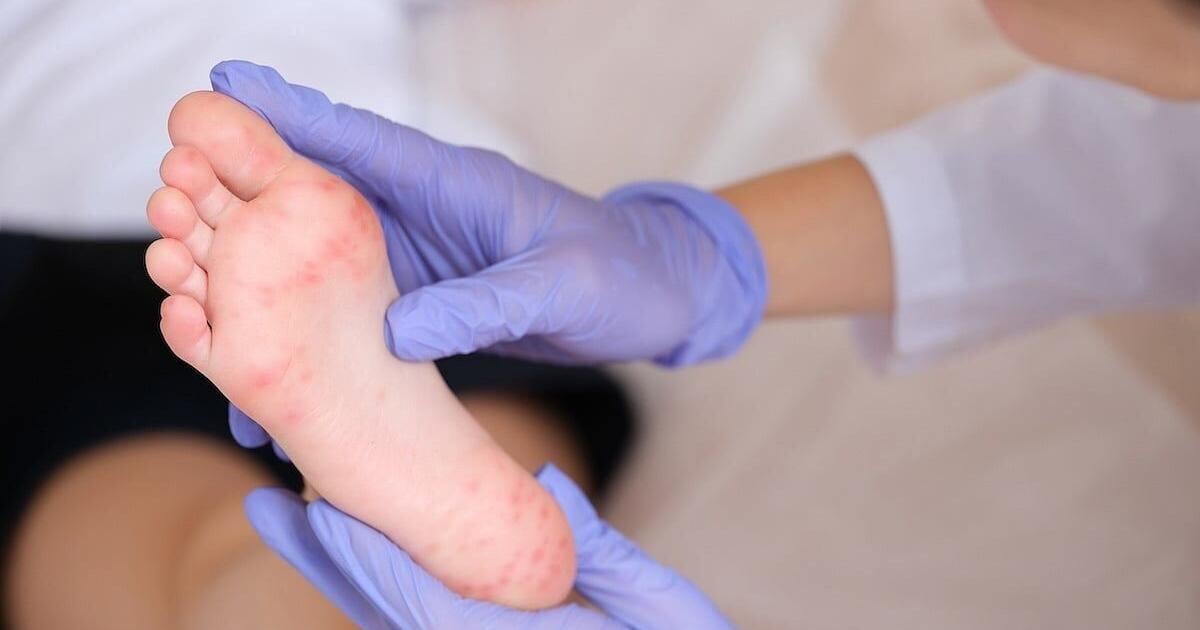 Houston Wastewater Foretold Texas Measles Outbreak | Health & Fitness