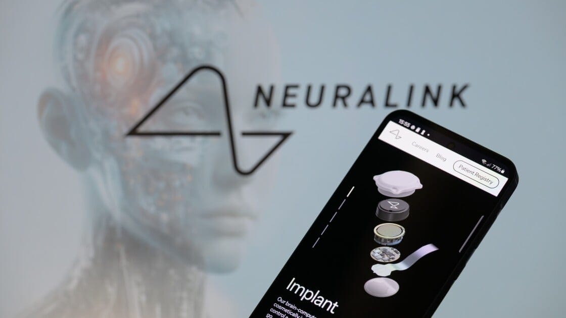 7 People Now Have Elon Musk’s Neuralink Brain Implant