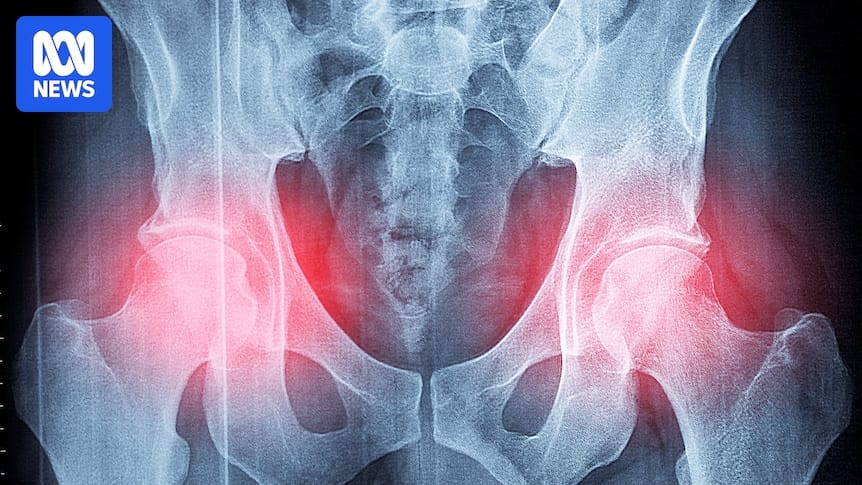 Study backing OsteoStrong ‘bone-strengthening’ exercise program should be retracted: experts